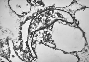 M,50y. | Pneumocystis carinii - lung